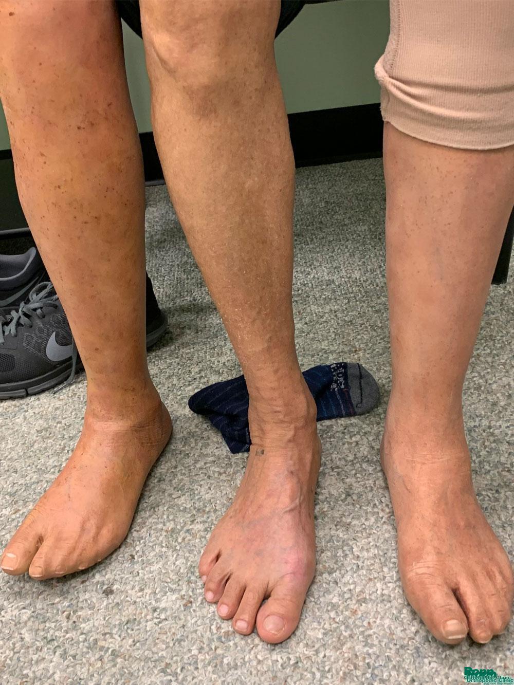 Matching silicone skin for two prostheses.